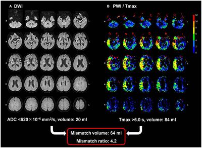 Penumbra Detection With Oxygen Extraction Fraction Using Magnetic Susceptibility in Patients With Acute Ischemic Stroke